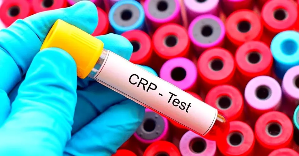 Üzərində «CRP - Test» yazılmış qan sınaq şüşəsi
