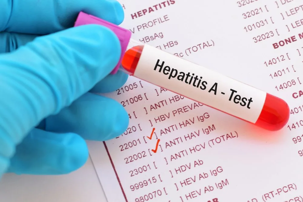 Üzərində «Hepatitis A - Test» yazılmış sınaq şüşəsi